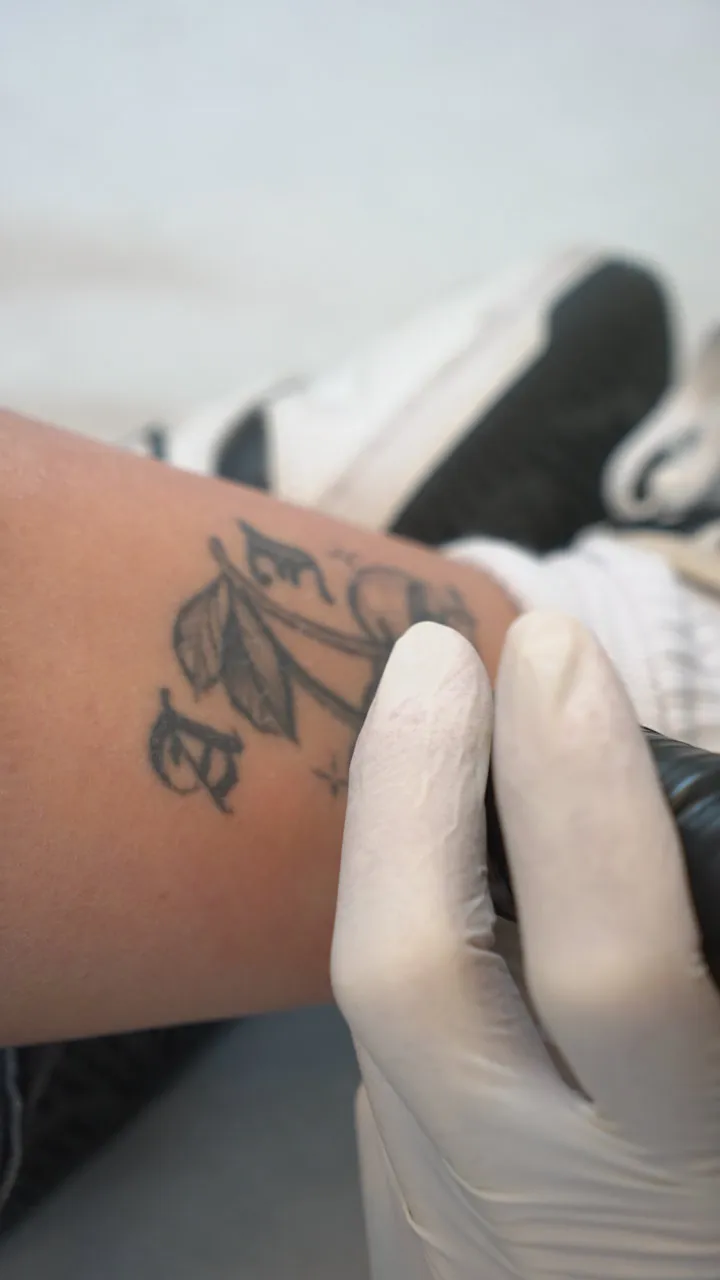tattoo removal brisbane
