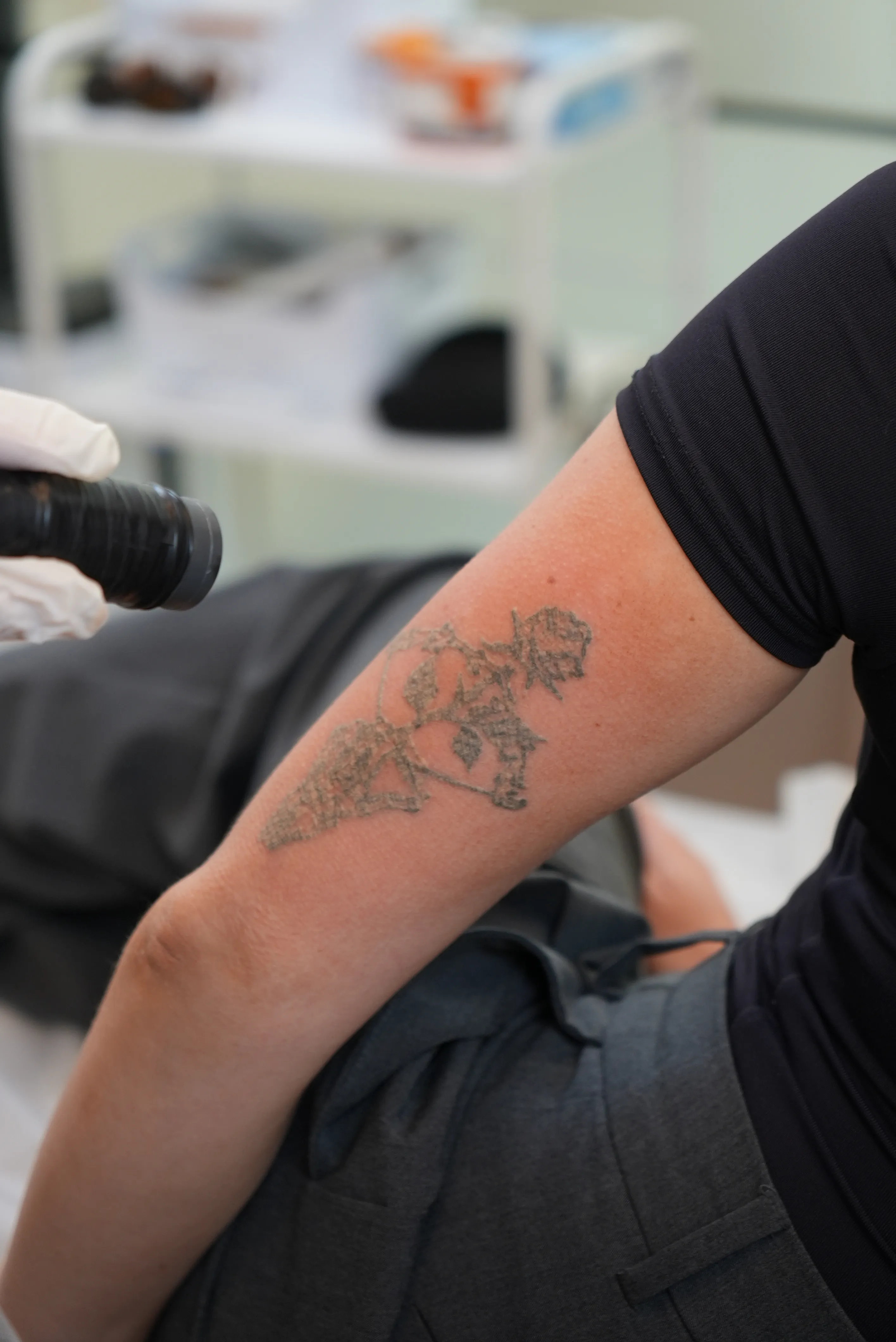 tattoo removal brisbane