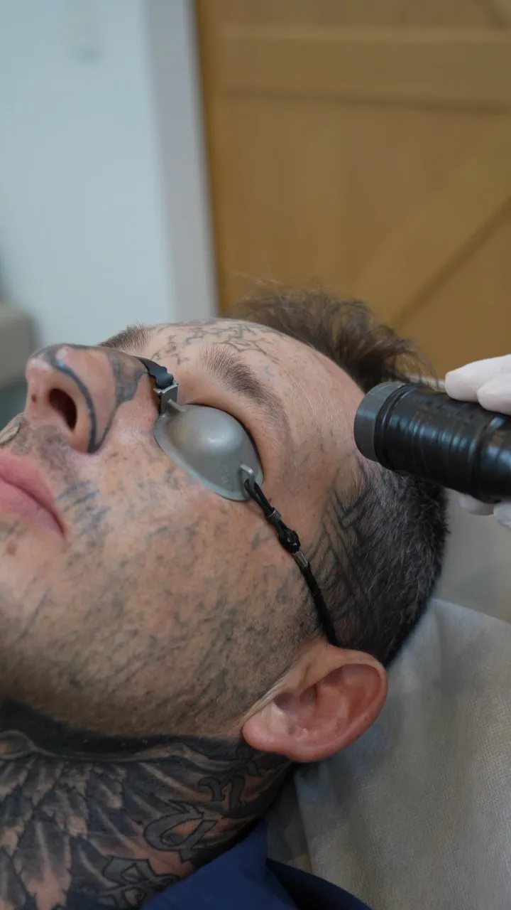 tattoo removal brisbane