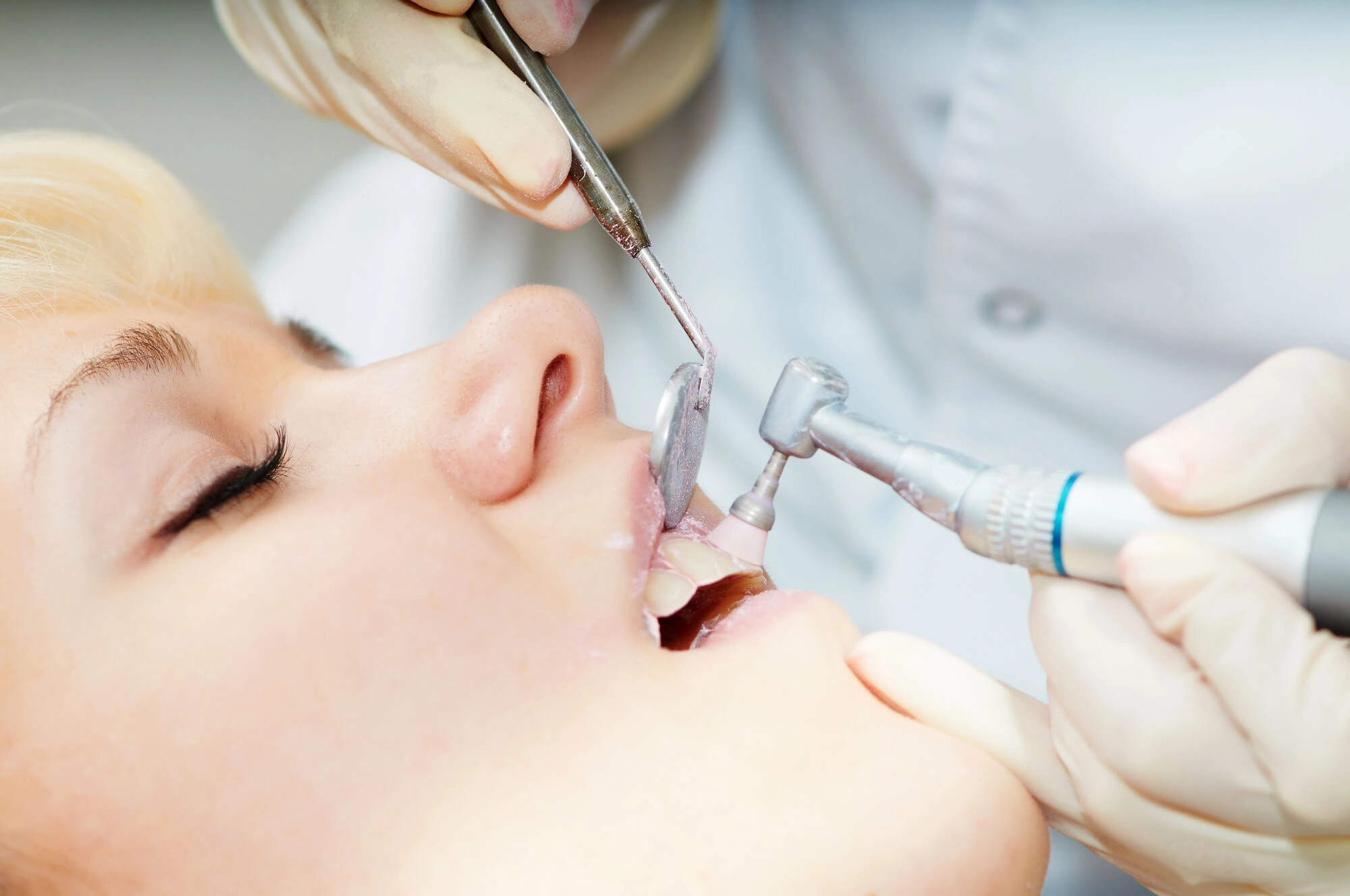 professional Teeth Cleaning in Fort Worth