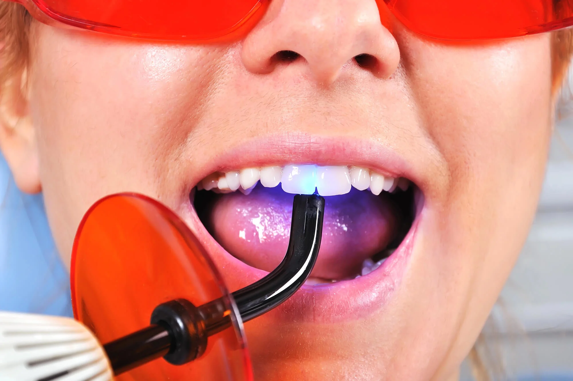woman in a dental filling process-dentist near north beach street