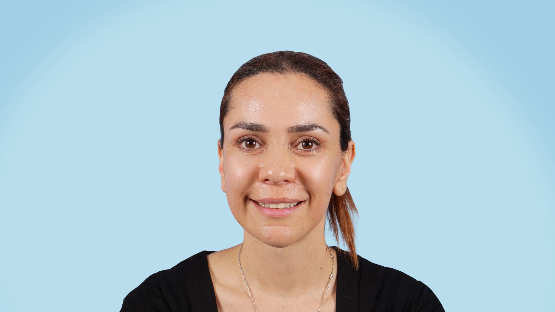 Paciente femenina después de una ritidoplastia Deep Plane. El resultado: contornos faciales más definidos, cuello rejuvenecido y una expresión más serena y armónica, sin perder naturalidad.