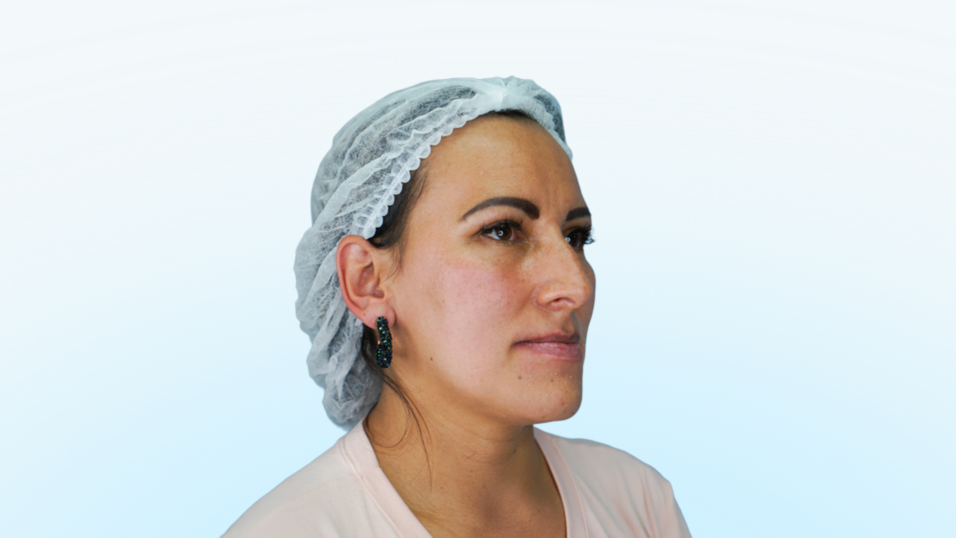 Paciente femenina en fase preoperatoria de septorrinoplastia y cirugía ortognática. Se observan desviación nasal y mandibular, con signos de envejecimiento facial y falta de armonía.