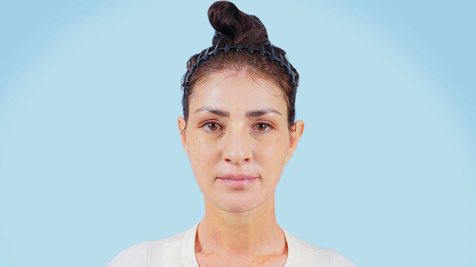 Paciente femenina en fase preoperatoria de rejuvenecimiento facial. Se aprecian signos de envejecimiento, piel flácida y pérdida de definición en mandíbula y cuello.