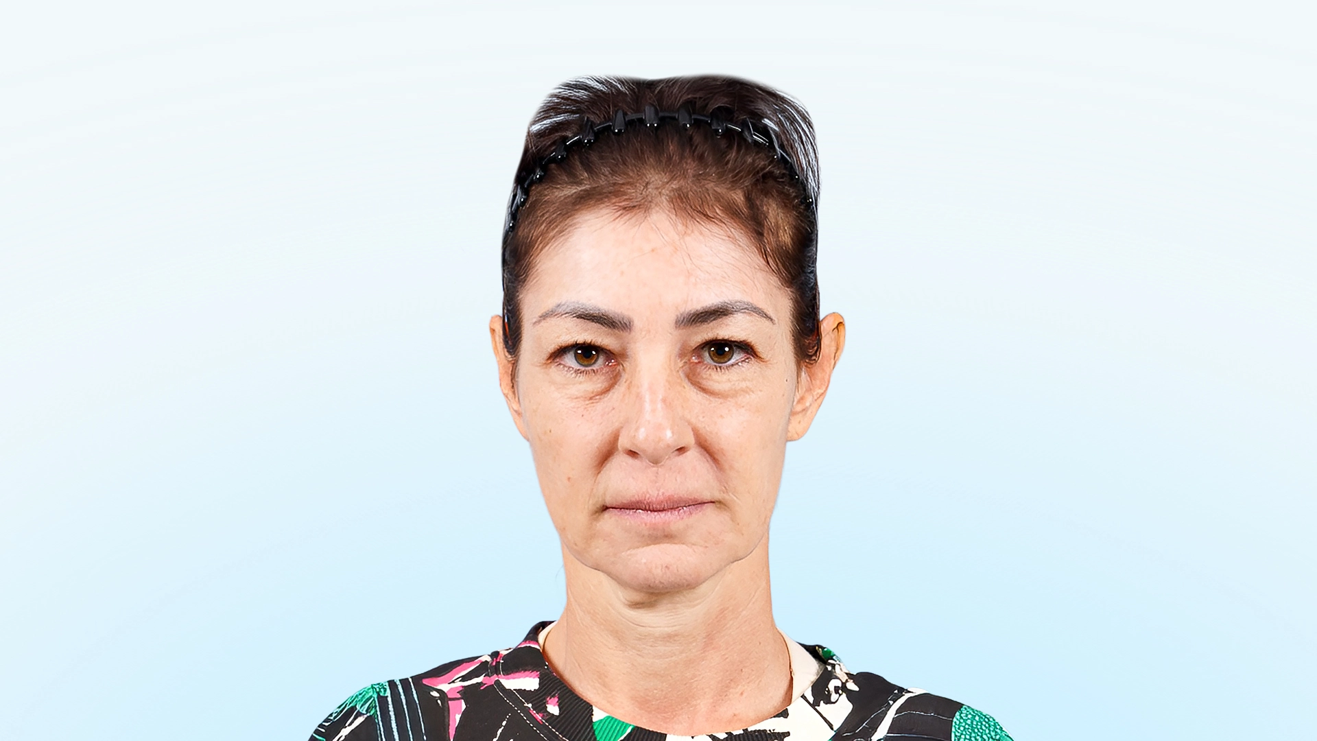 Resultado postoperatorio tras ritidoplastia, cervicoplastia y blefaroplastia. Contornos faciales definidos, mirada rejuvenecida y expresión natural.