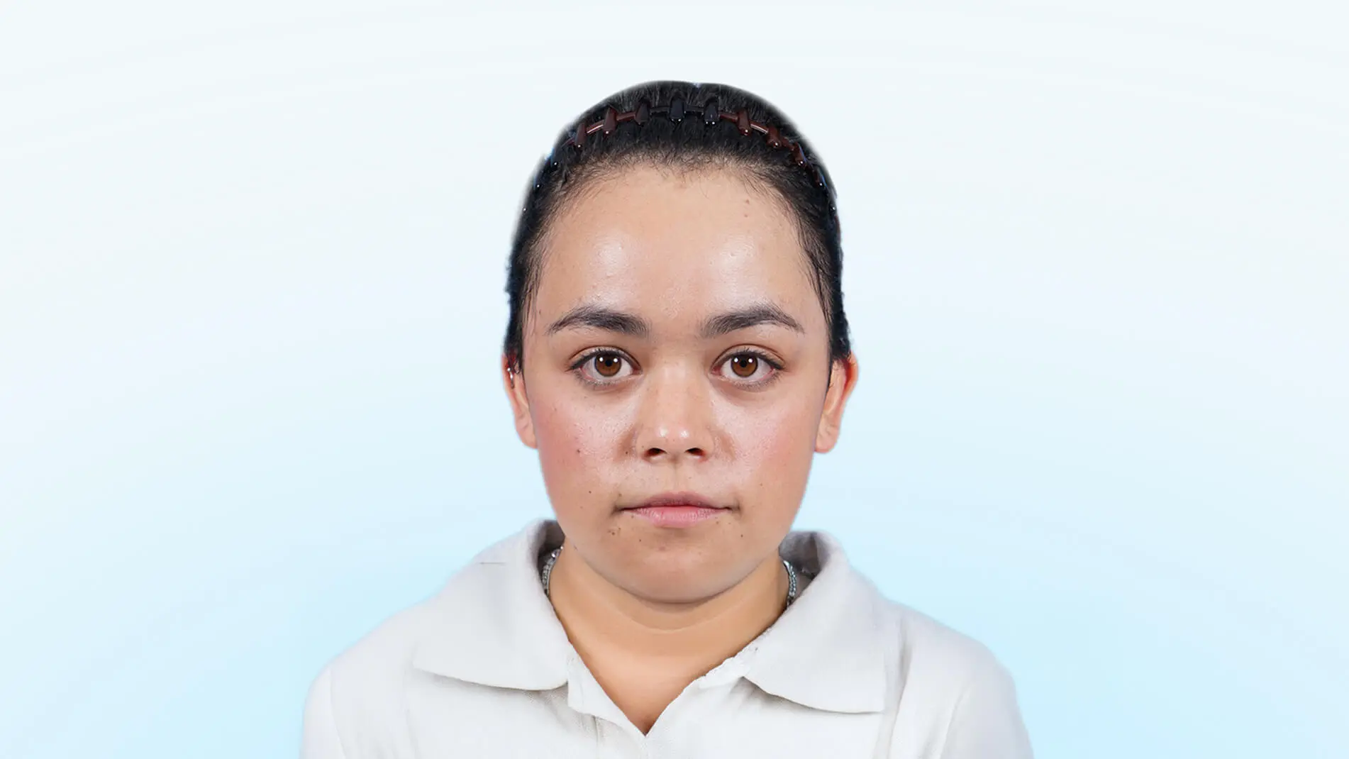 Paciente femenina en fase preoperatoria con frente amplia y línea de cabello alta.