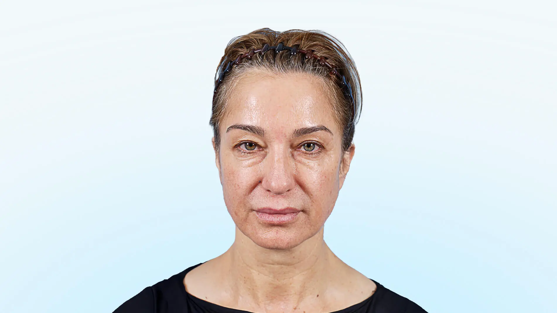 Paciente femenina con párpados caídos y cola de ceja baja, en fase preoperatoria.