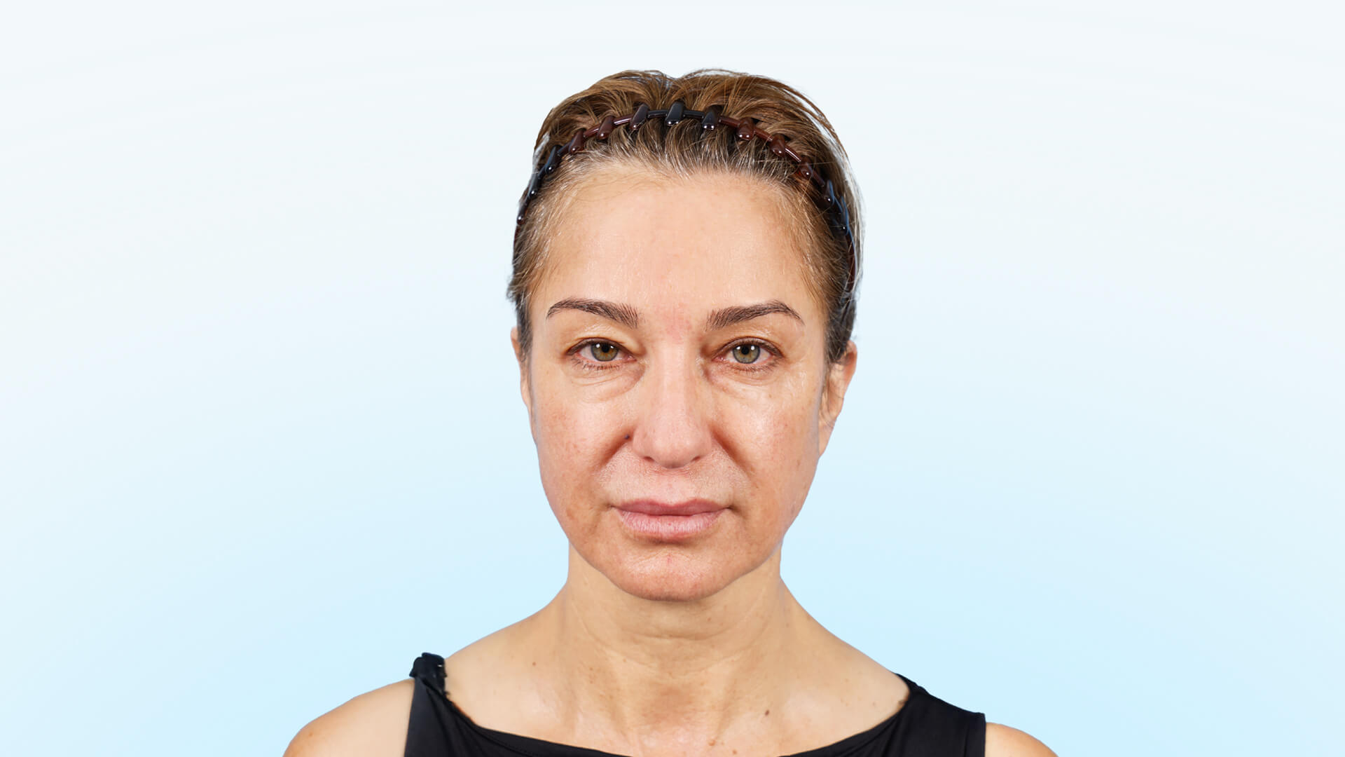 Paciente femenina con párpados caídos y cola de ceja baja, en fase preoperatoria.