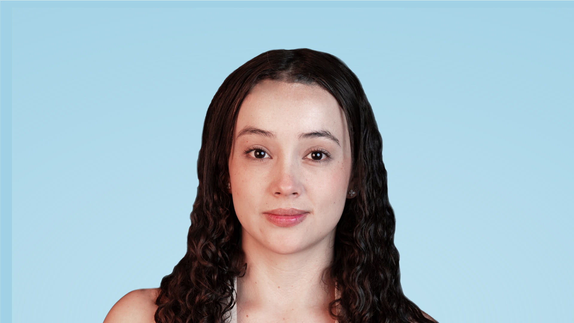 Resultado postoperatorio de frontoplastia de avance con línea capilar adelantada, frente más armónica y proporción facial equilibrada.
