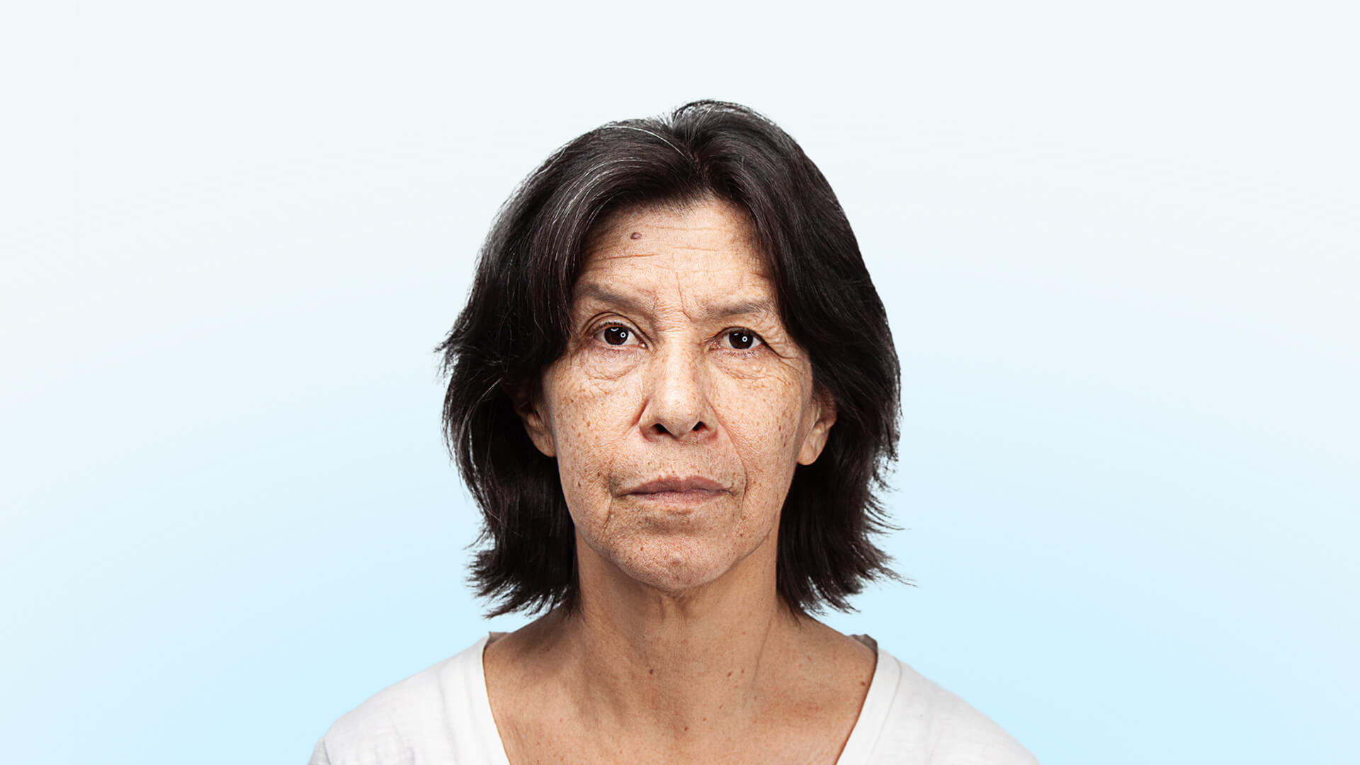 Paciente adulta con signos de envejecimiento facial y cervical, flacidez en rostro, cuello y párpados, previa a rejuvenecimiento facial total.