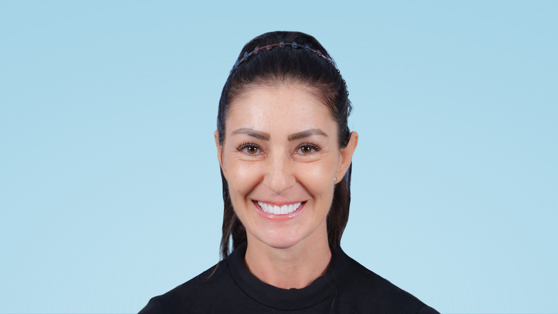 Paciente femenina en fase preoperatoria de rejuvenecimiento facial. Se aprecian signos de envejecimiento, piel flácida y pérdida de definición en mandíbula y cuello.