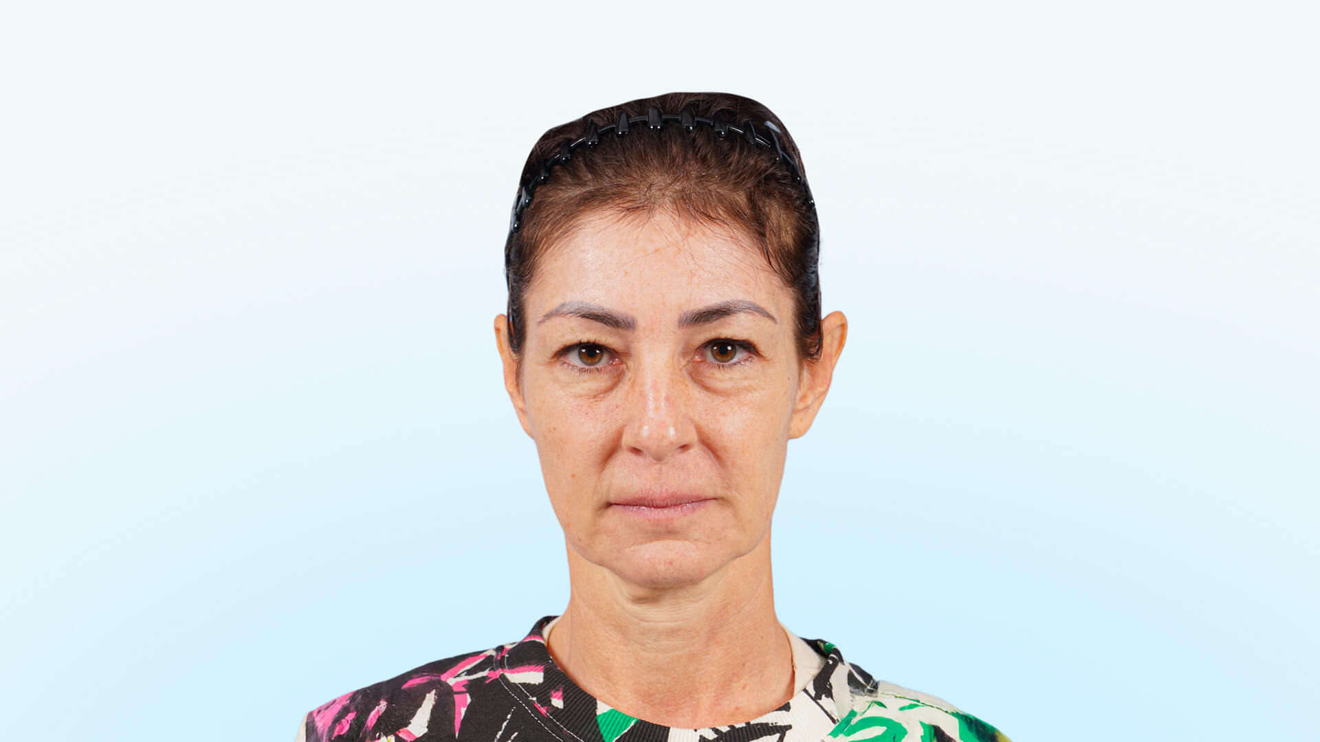 Resultado postoperatorio tras ritidoplastia, cervicoplastia y blefaroplastia. Contornos faciales definidos, mirada rejuvenecida y expresión natural.