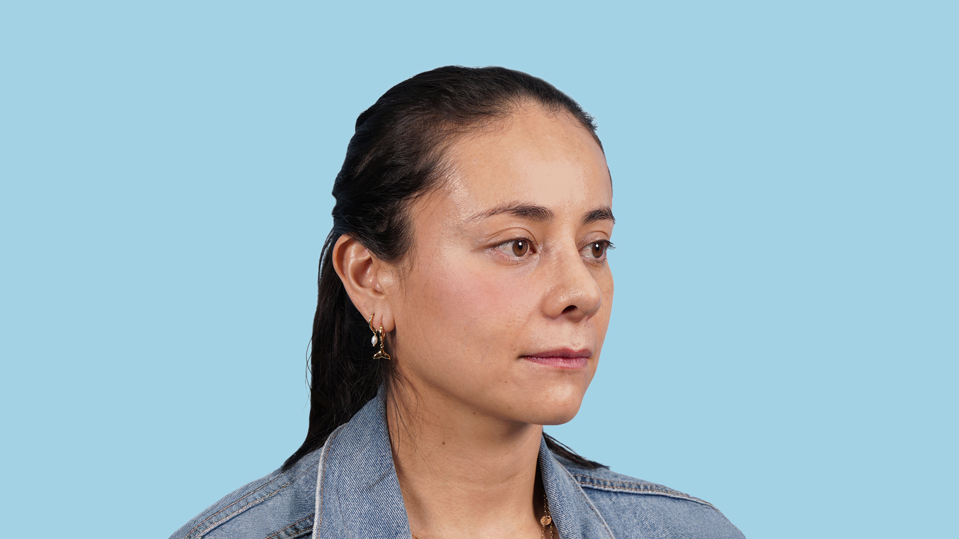 Resultado postoperatorio de septorrinoplastia secundaria con mejoría funcional, respiratoria y nariz armónica, natural y proporcionada al rostro.