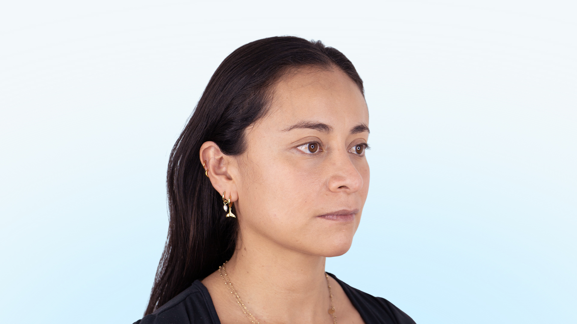 Paciente con secuelas de cirugía nasal previa, desviación estructural y obstrucción nasal que afecta la respiración.