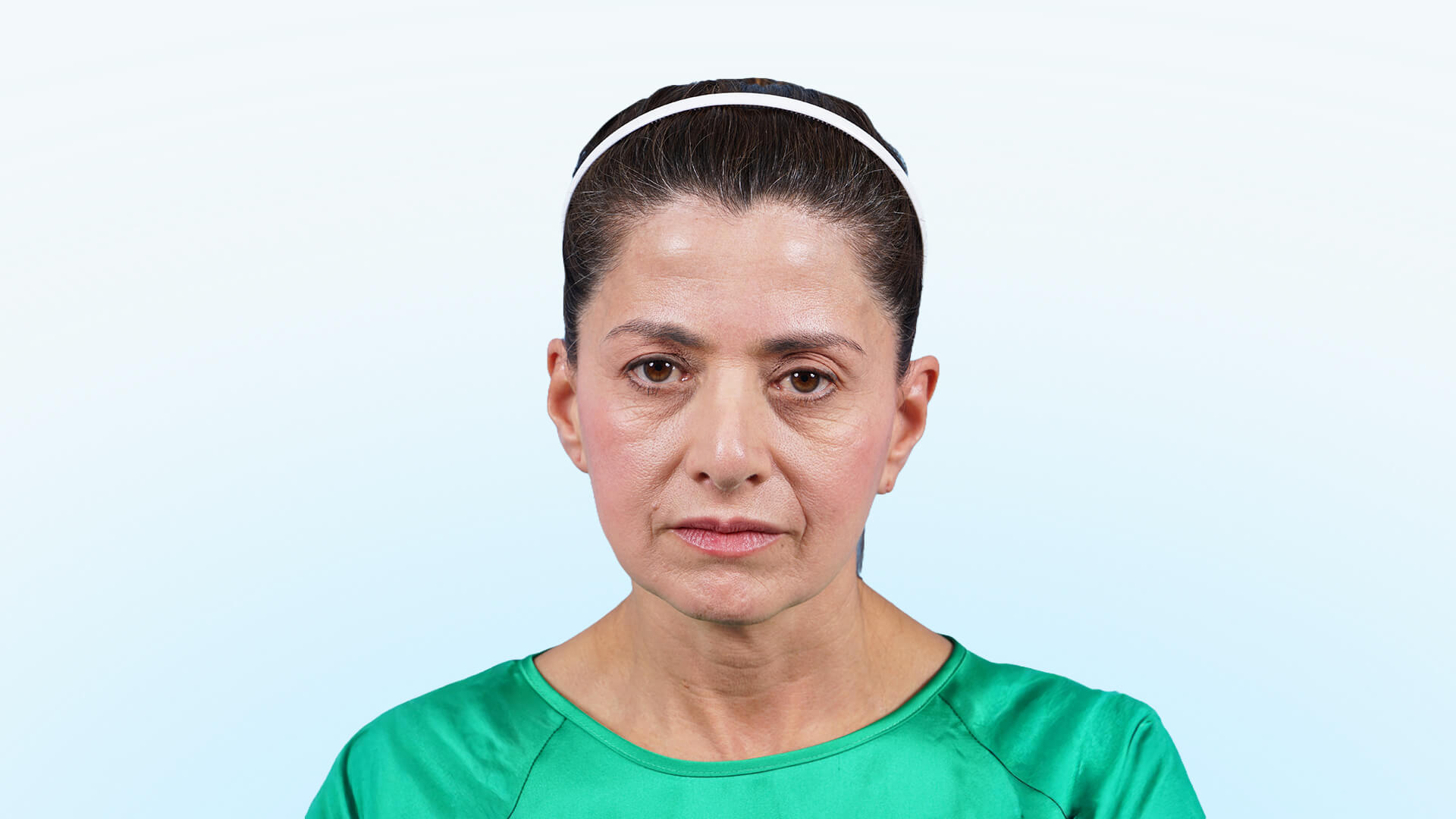 Paciente de Bogotá con mirada cansada, exceso de piel en párpados superiores, descenso de la cola de la ceja y perfil nasal desarmónico previo a blefaroplastia, frontoplastia endoscópica y septorrinoplastia.Alt – Después: