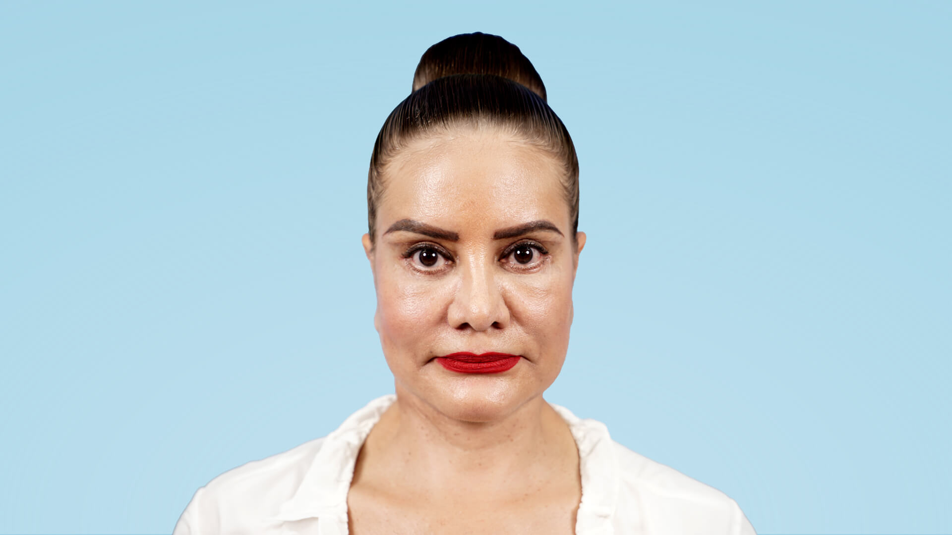 Resultado de rejuvenecimiento facial total tras un año, mostrando una piel firme, mirada vital y contorno mandibular definido con técnica Deep Plane.