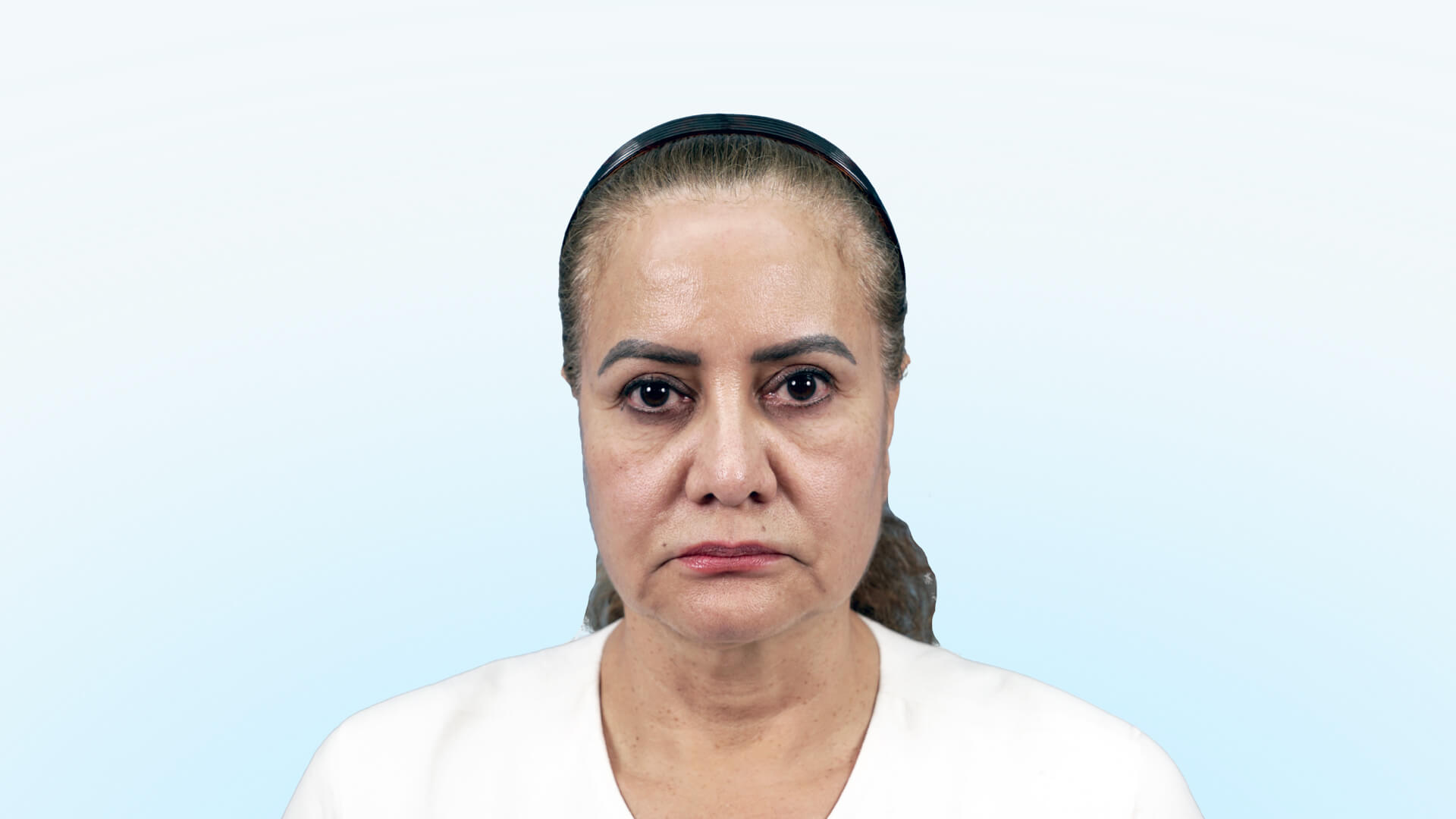 Paciente colombiana residente en EE. UU. con signos de flacidez facial y pérdida de definición cervical antes de su cirugía.