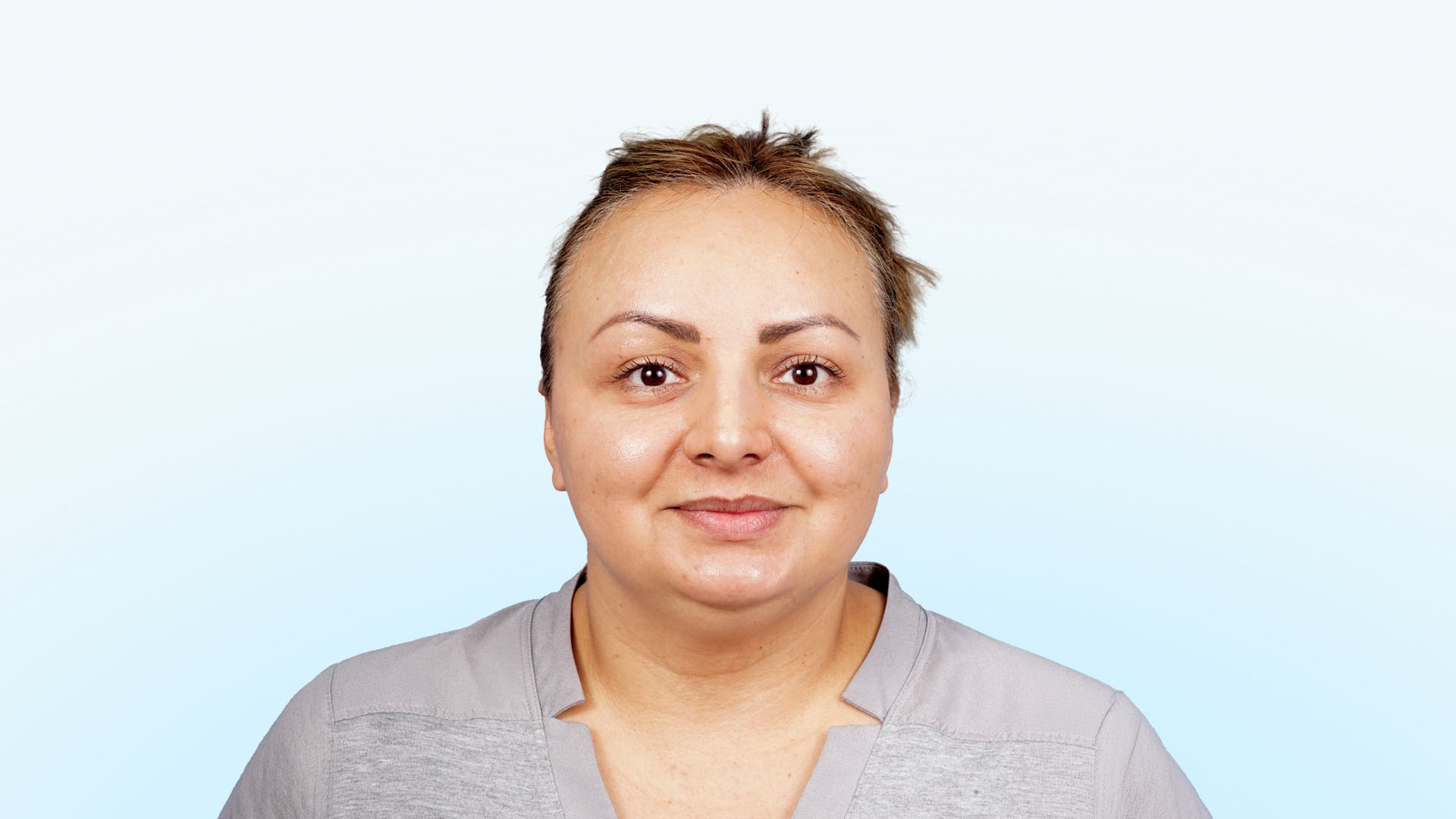 Paciente antes de la frontoplastia de avance y rejuvenecimiento facial, con signos visibles de envejecimiento y expresión de cansancio.