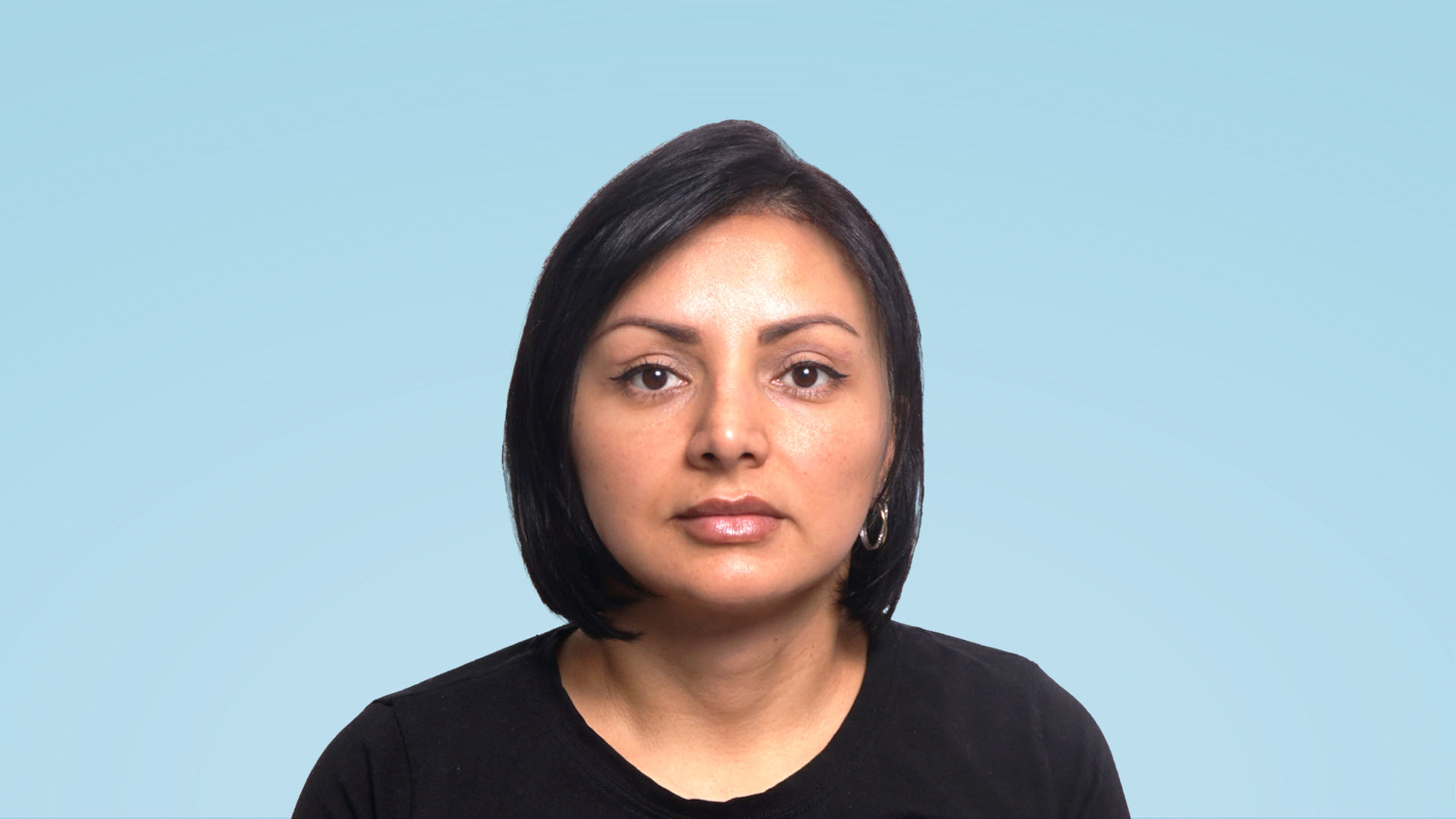 Paciente después de la frontoplastia de avance y rejuvenecimiento facial, con una apariencia rejuvenecida y una expresión más fresca y armónica.