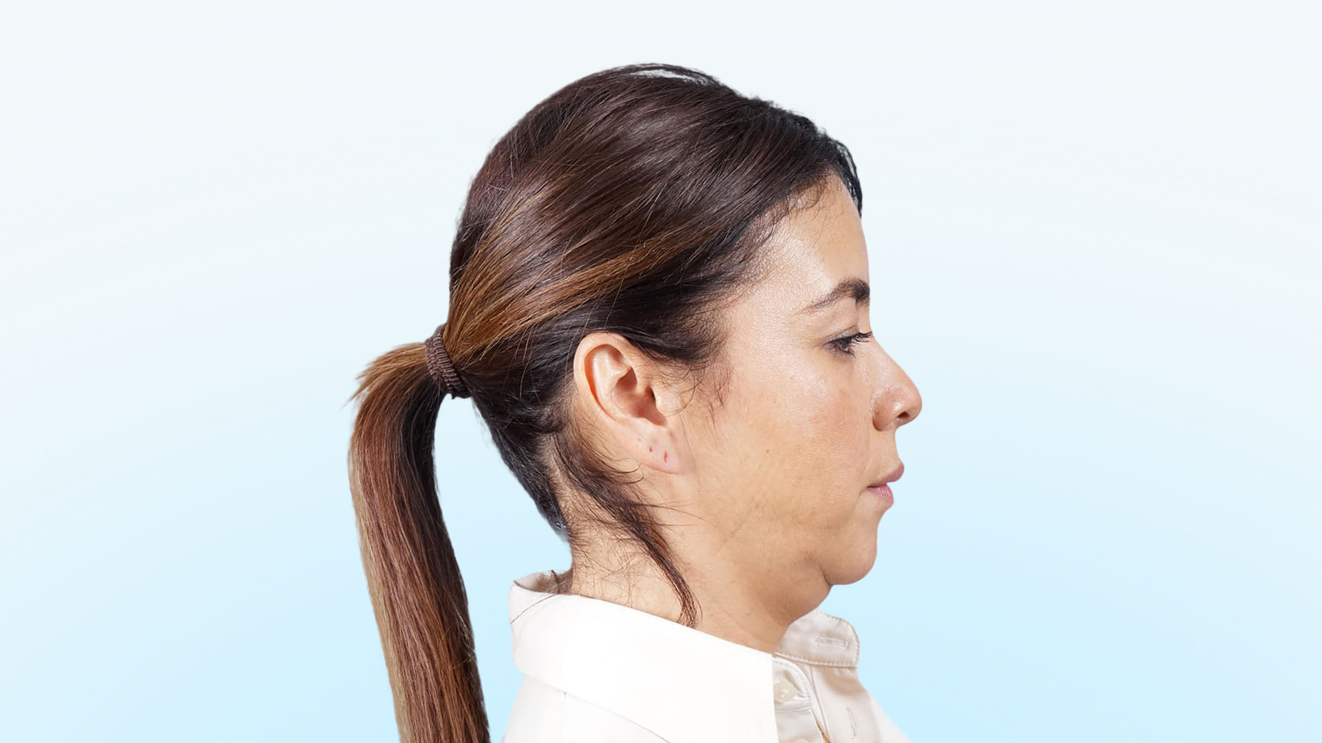 Paciente antes de la cervicoplastia, blefaroplastia y septorrinoplastia, con signos visibles de envejecimiento en el cuello, párpados y perfil nasal, lo cual le daba una apariencia de mayor edad.
