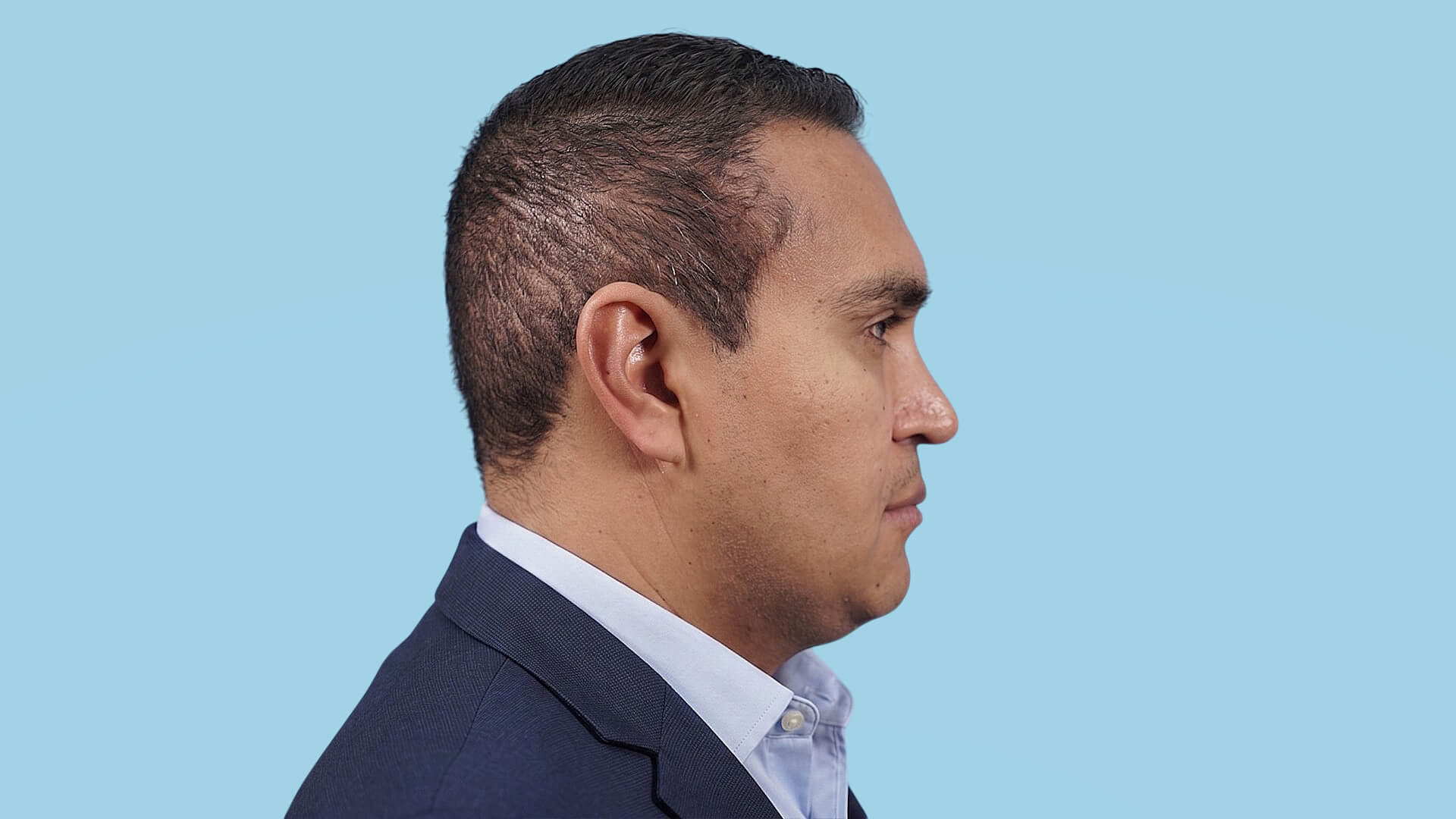 Resultado de cervicoplastia con cuello definido, ángulo cervicomental rejuvenecido y línea mandibular más firme y natural.
