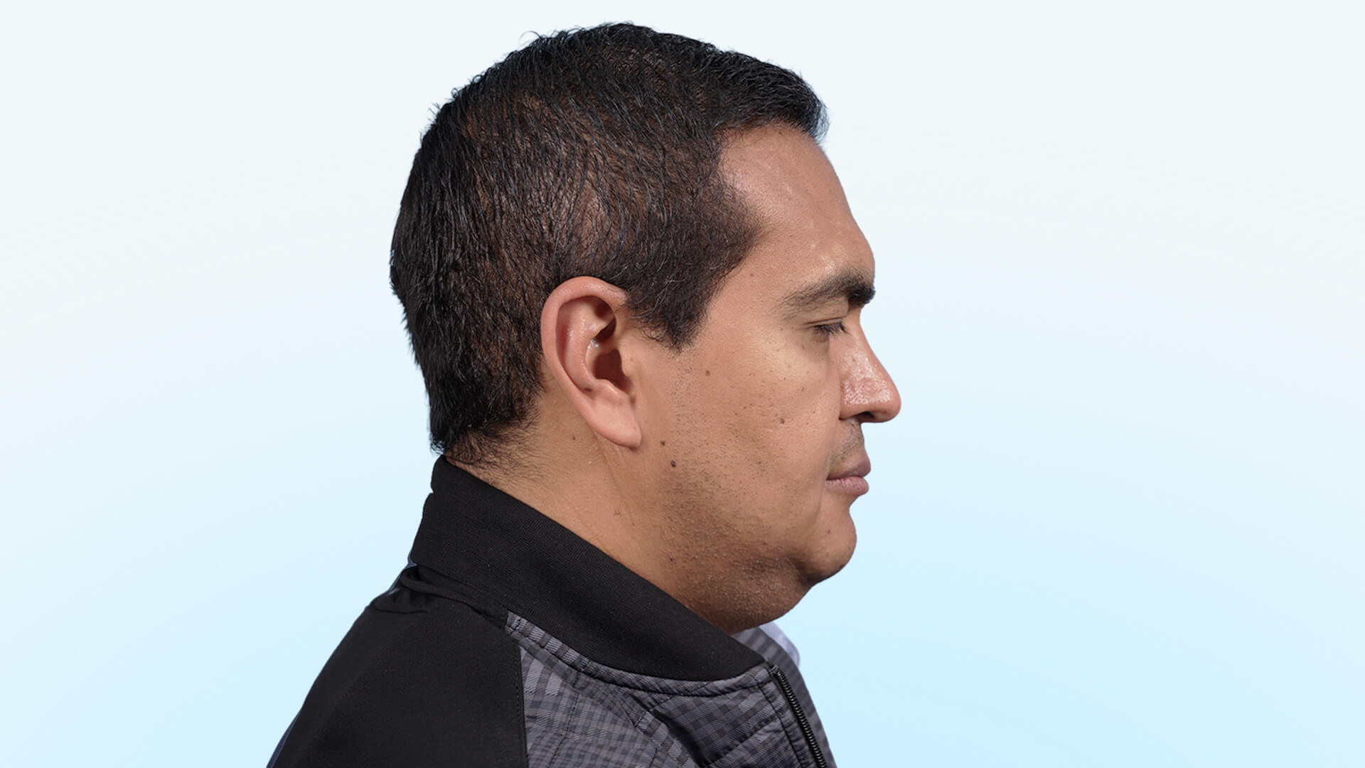  Paciente masculino con flacidez cervical, pérdida de definición mandibular y bandas platismales antes de cervicoplastia.
