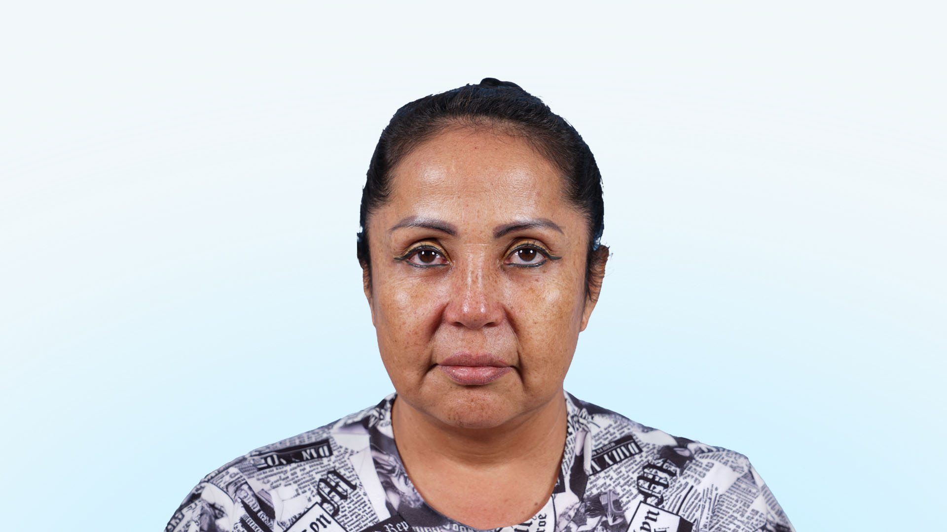 Paciente presentando flacidez facial y necesidad de mejora funcional nasal antes de su ritidoplastia y procedimientos combinados.