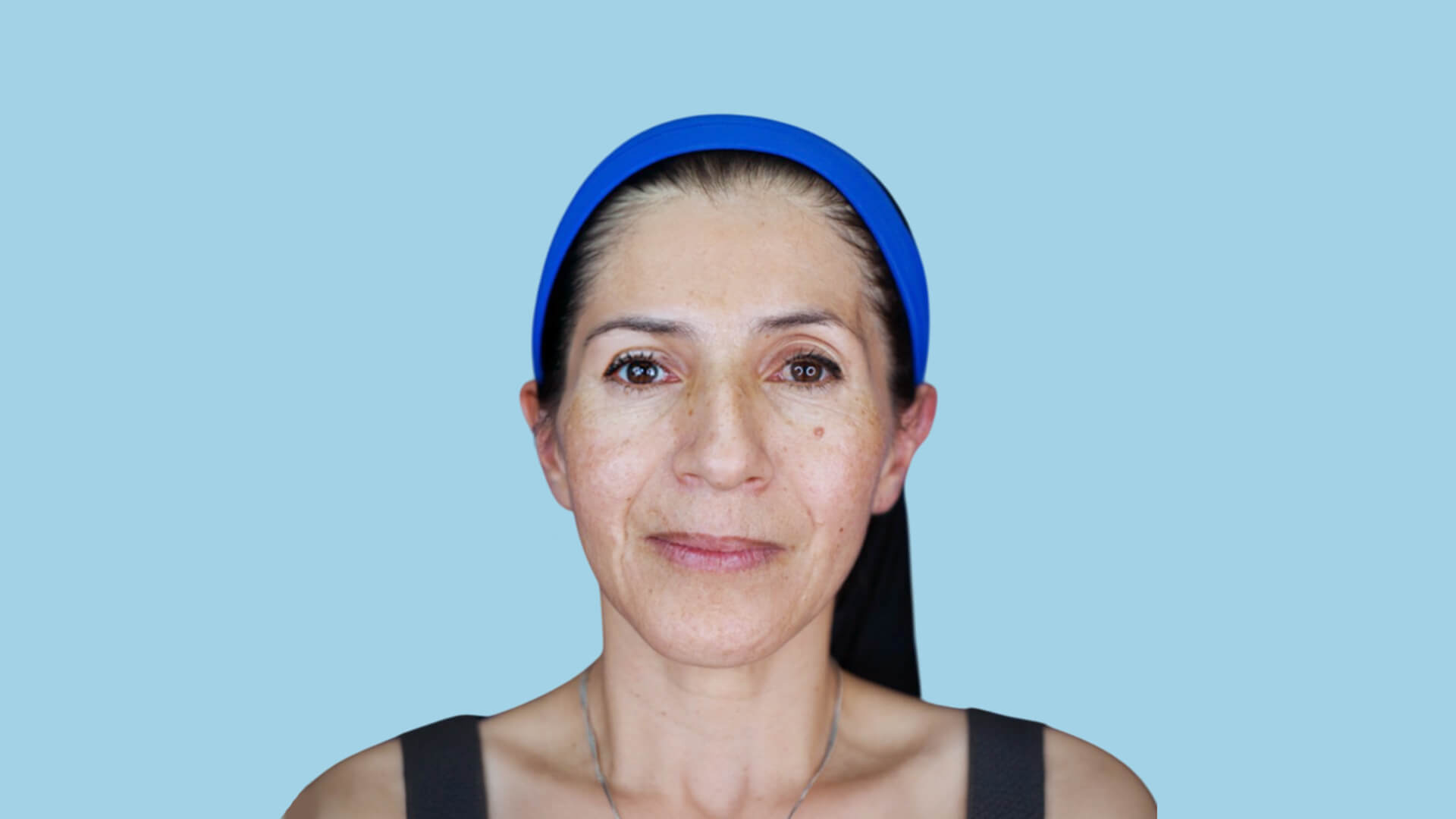  Resultado real de rejuvenecimiento facial total tras ritidoplastia deep plane, blefaroplastia y cervicoplastia realizada en Bogotá por el Dr. Jorge Espinosa, mostrando una mandíbula definida, cuello estilizado y expresión natural.
