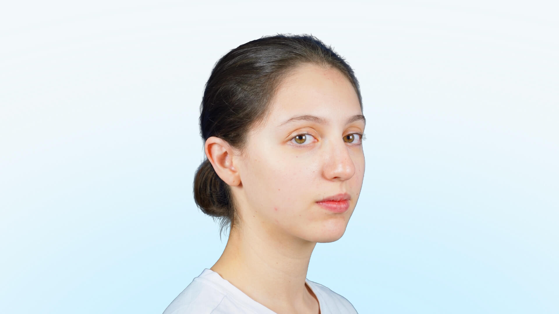 Paciente joven en Bogotá con desviación nasal y perfil con ligera giba dorsal antes de su cirugía de septorrinoplastia funcional y estética.