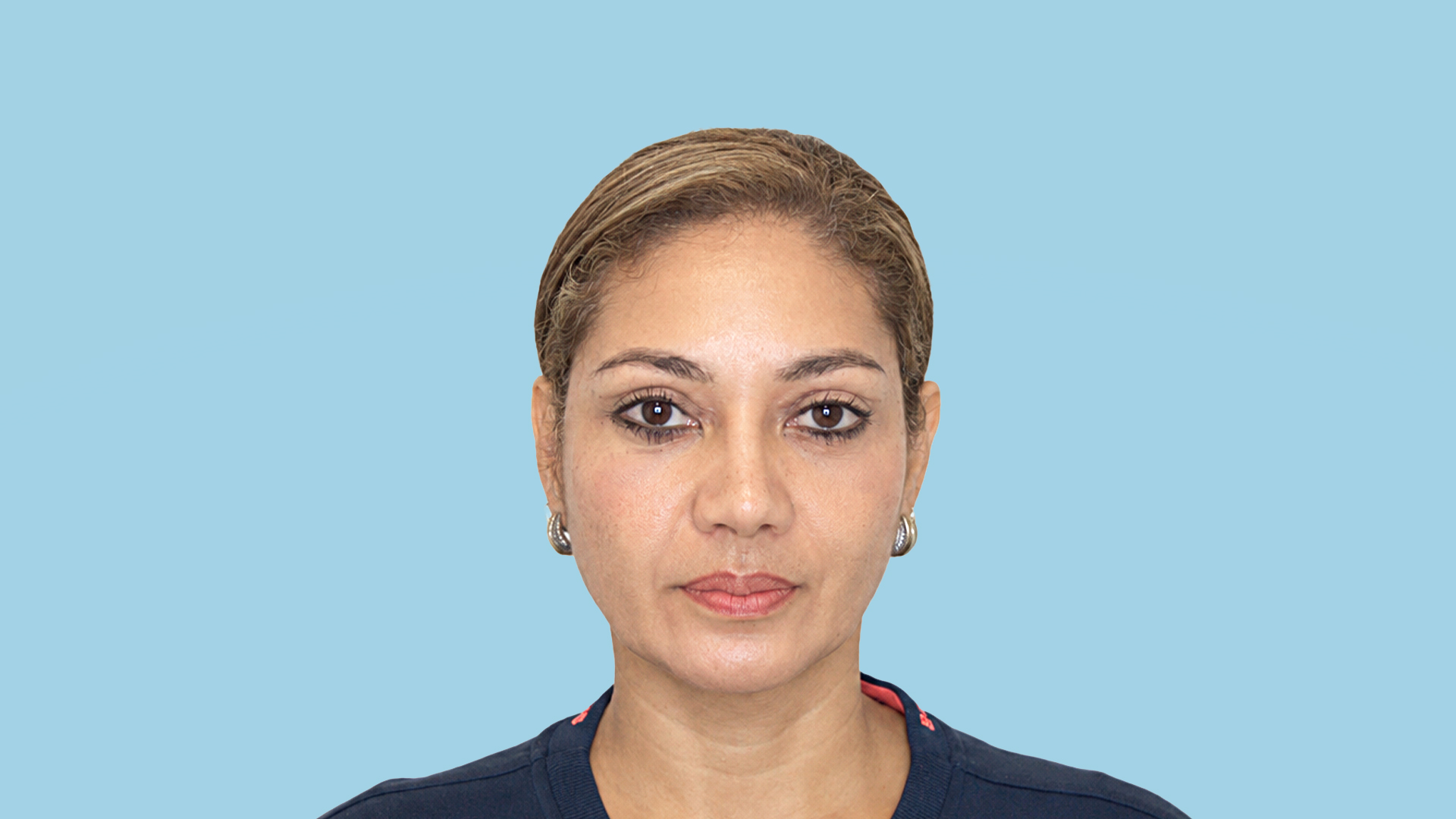 Resultado real a los 15 días de suspensión de cola de cejas, blefaroplastia y septorrinoplastia por el Dr. Jorge Espinosa, mostrando una mirada descansada, joven y una nariz armónica y natural.