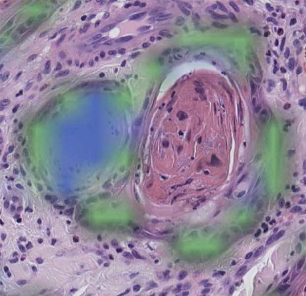 Image of stain - perineural invasion real mask - green tumour, blue nerve with overlays