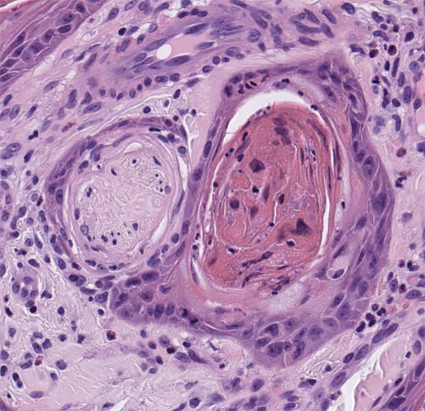 Image of stain - perineural invasion real mask - green tumour, blue nerve