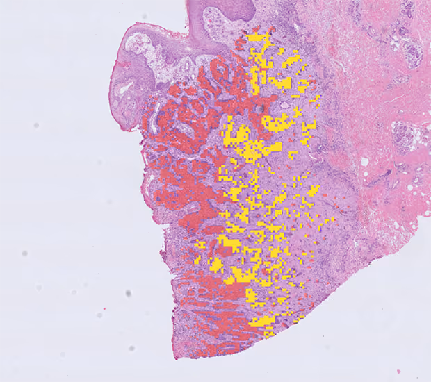 Image of stain of skin with basal cell carcinoma with multi-colour overlay