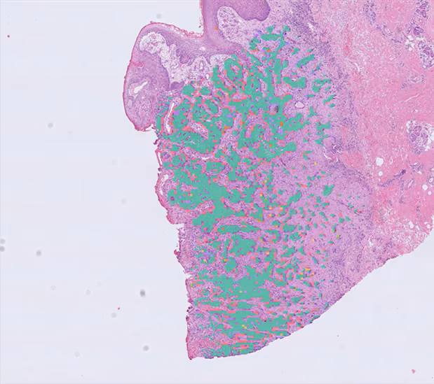 Image of stain of skin with basal cell carcinoma with green overaly