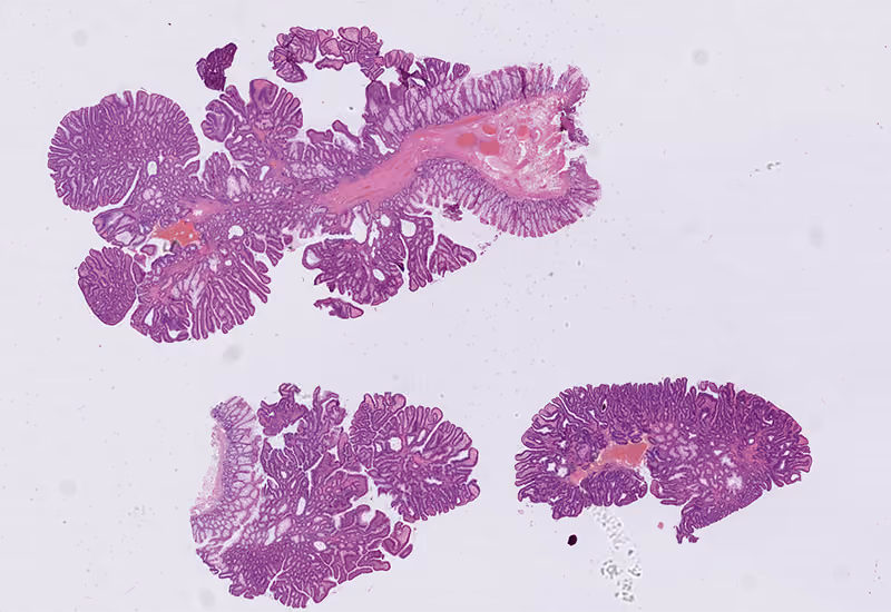 Image of stain of colon, tubulovillous adenoma