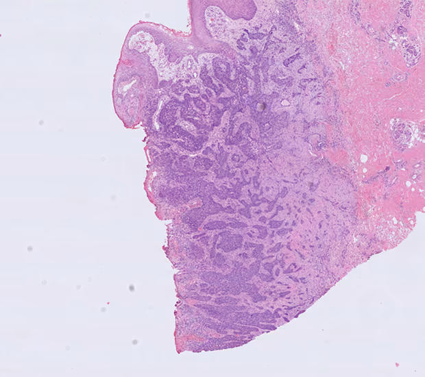 Image of stain of skin with basal cell carcinoma