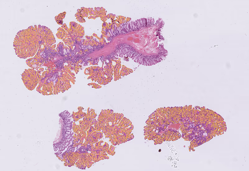 Image of stain of colon, tubulovillous adenoma with overalys