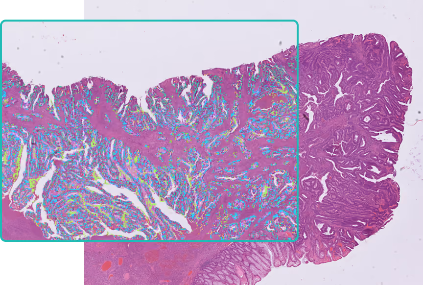 Image showcasing a partial overlay cutout over stain image of colon, tubulovillous adenoma