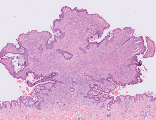 Image of stain - H&E, compound nevus, both surfaces