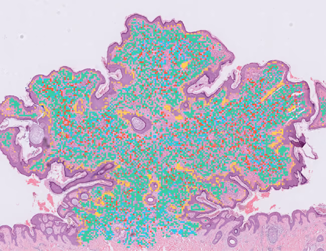 Image of stain - H&E, compound nevus, both surfaces - same field with overlays