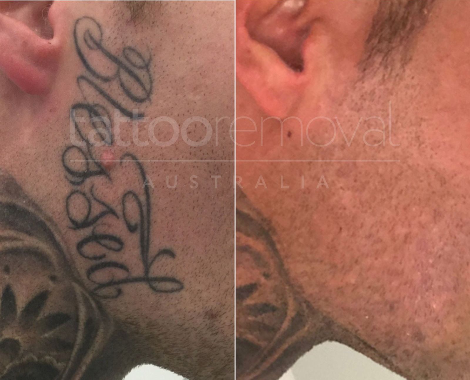 Laser Tattoo Removal