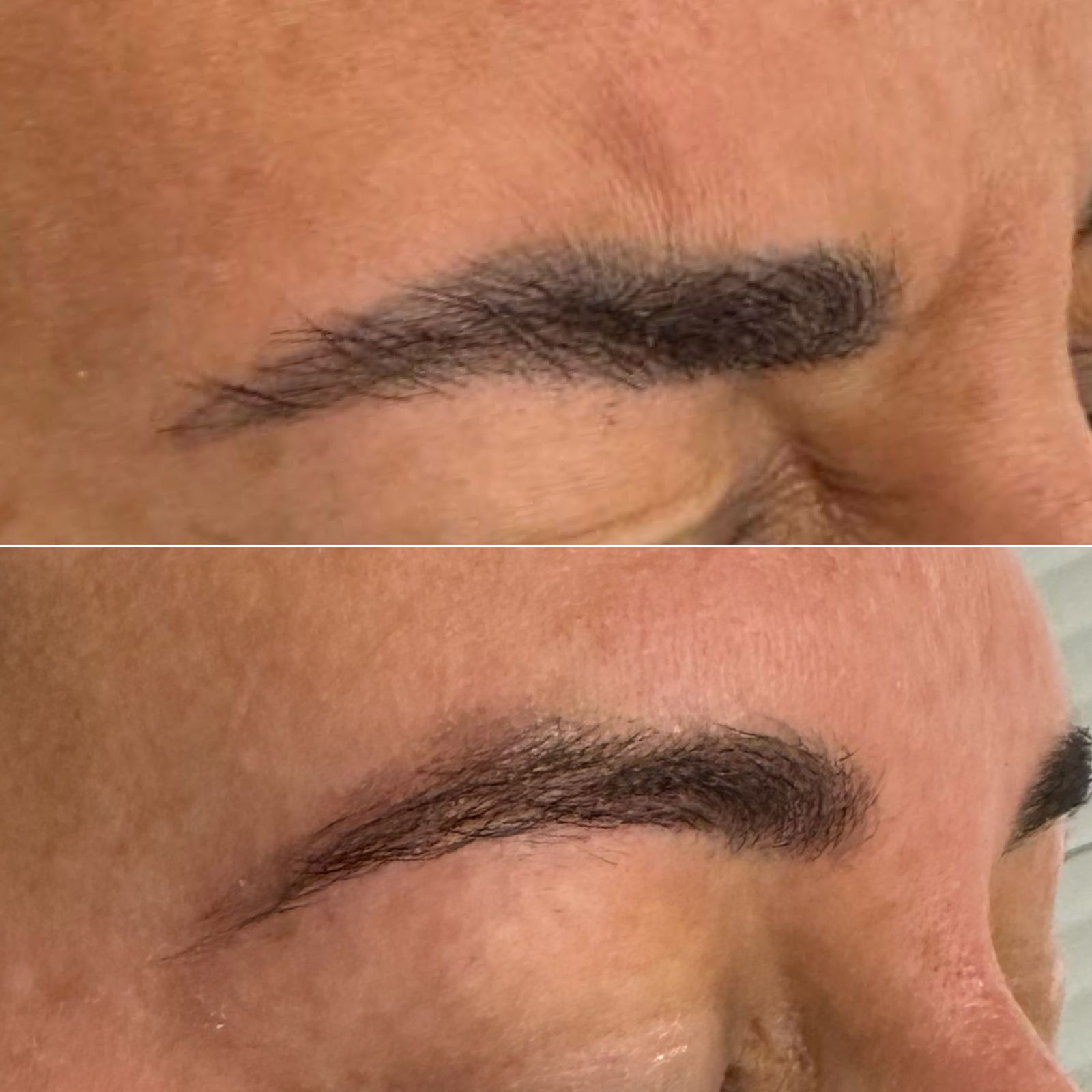 Laser Tattoo Removal