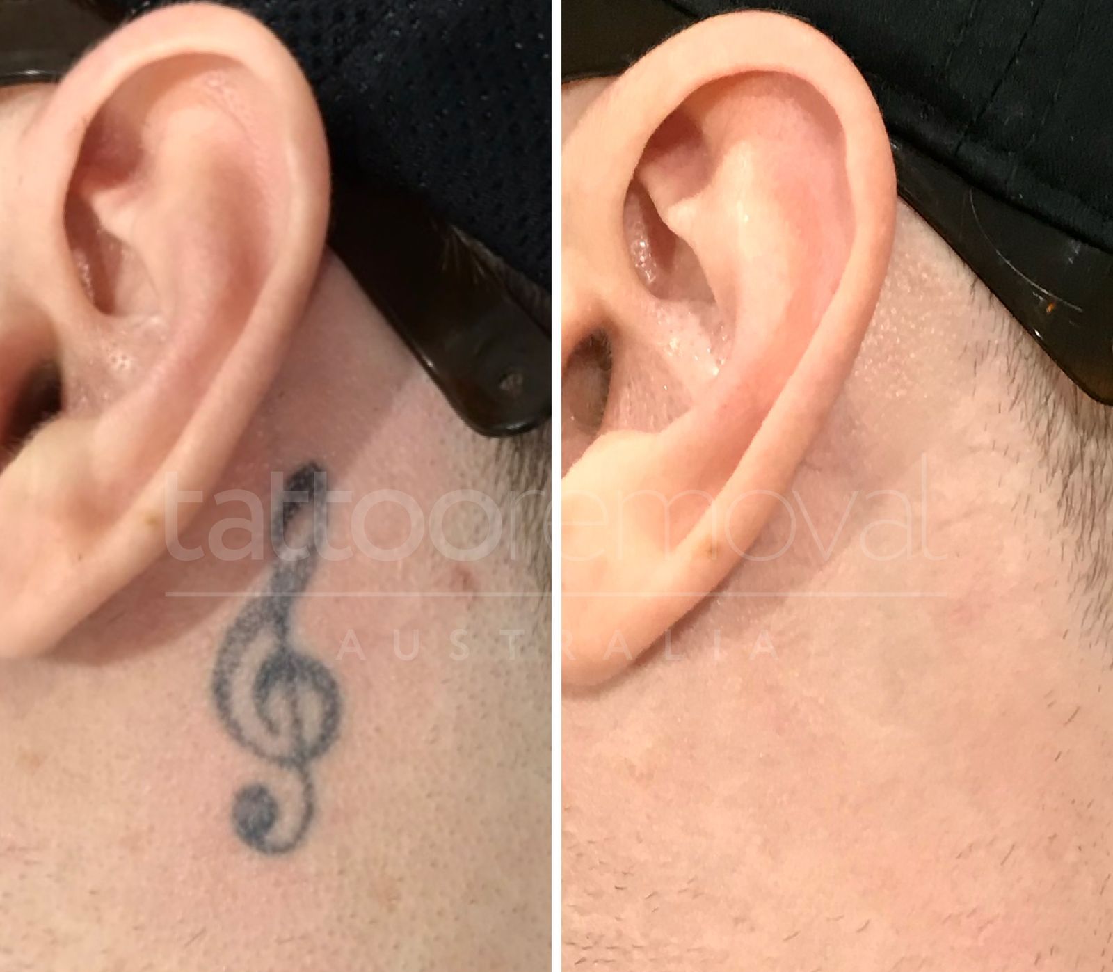 Laser Tattoo Removal