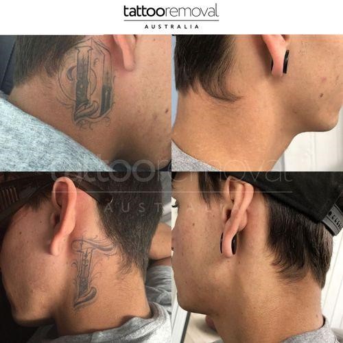 Laser Tattoo Removal