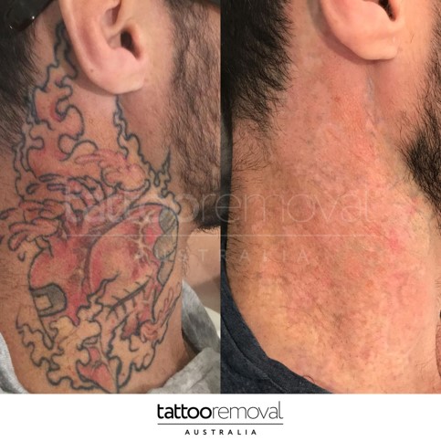 Laser Tattoo Removal