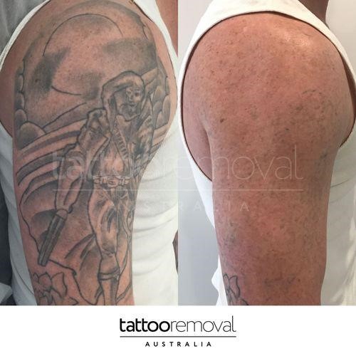 Laser Tattoo Removal
