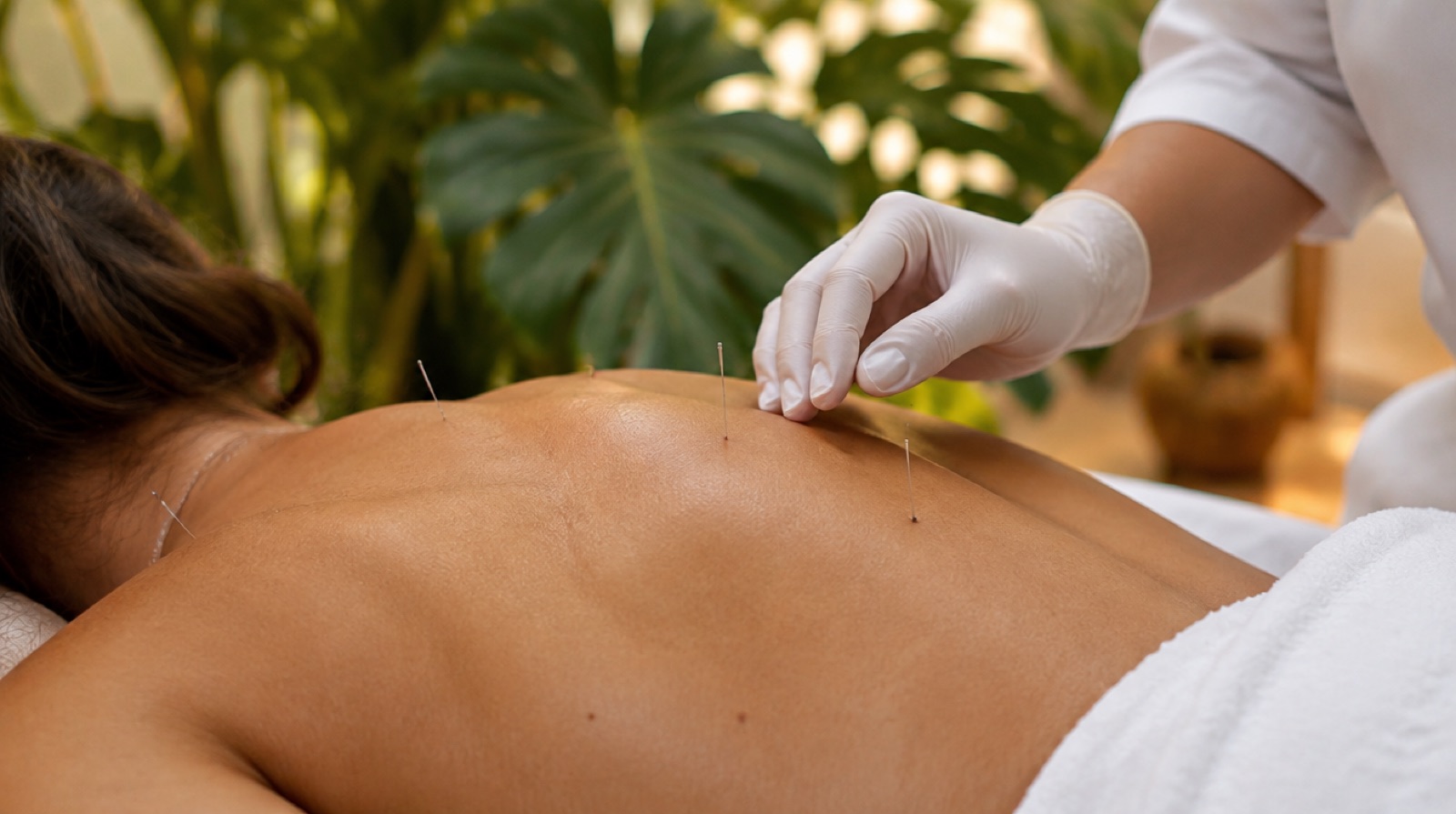 Licensed acupuncturist placing fine acupuncture needles on a patient's upper back