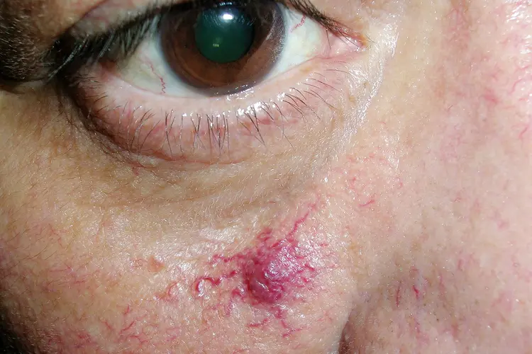 Understanding Telangiectasia: What Causes It and How to Treat It Naturally