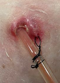 Image of human hand with Chinese finger trap shown on index finger