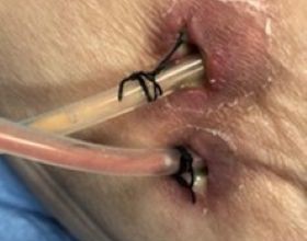 Image of human hand with Chinese finger trap shown on index finger